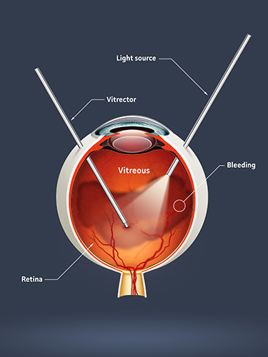 use of sulfur hexafluoride (sf6) in vitrectomy